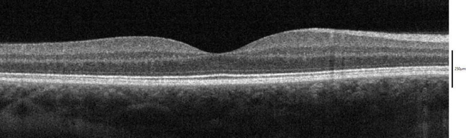 Normal SD-OCT in a lupus patient