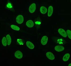 Microscopic view of a positive fluorescent antinuclear antibody test used to diagnose a lupus patient