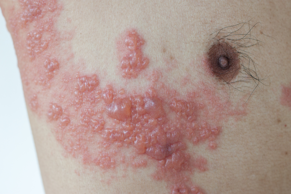 Image of a man with herpes zoster rash across chest