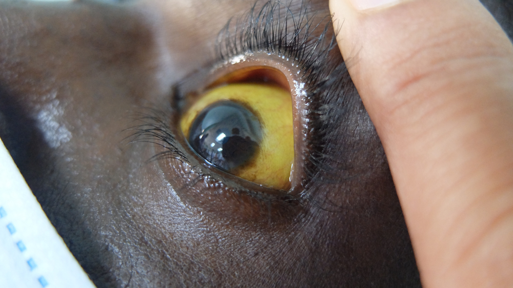 yellow eye from jaundice due to hepatitis