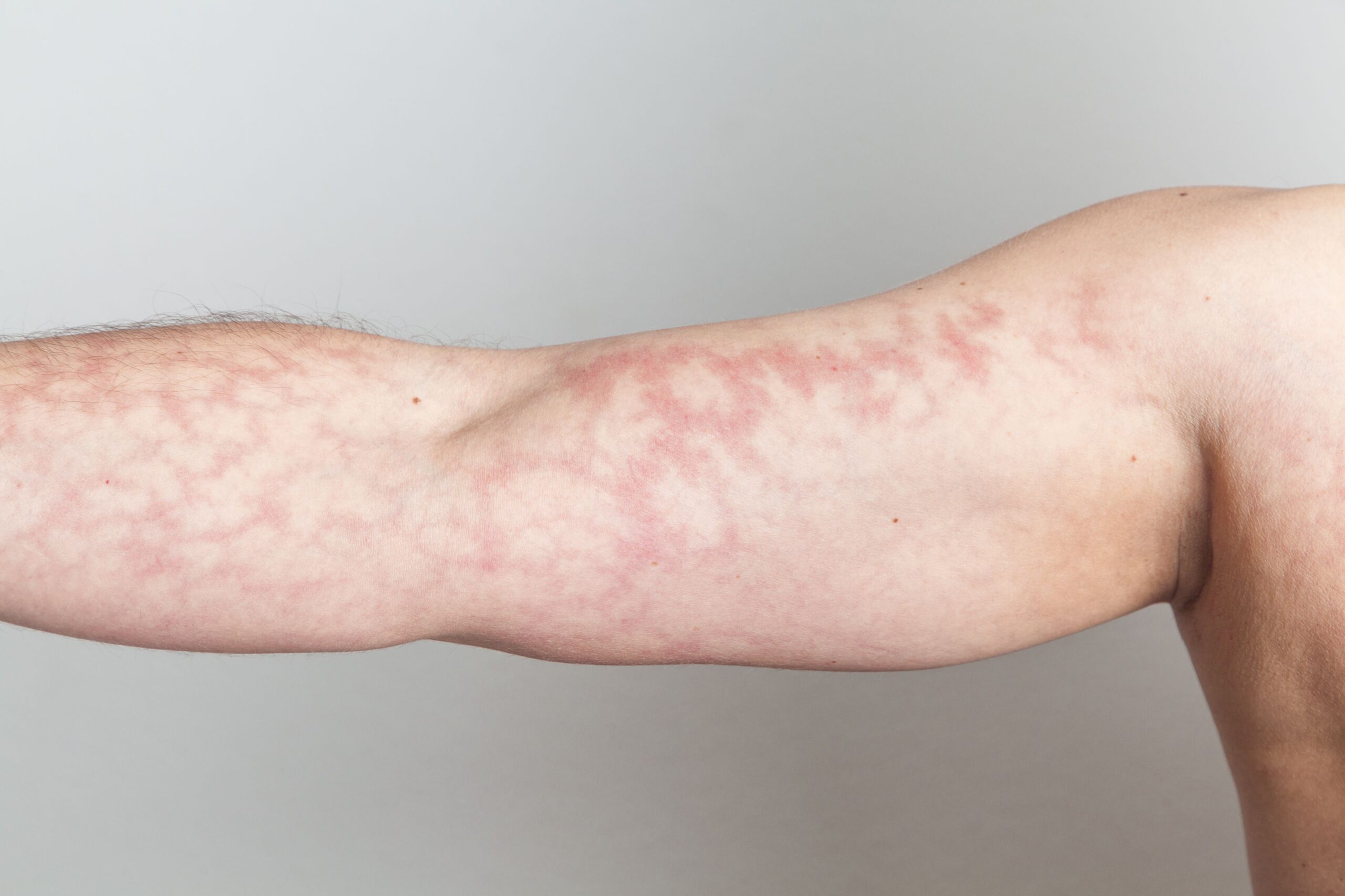 Lupus Mottled Skin And The Symptoms Updated August 2024 The Lupus 