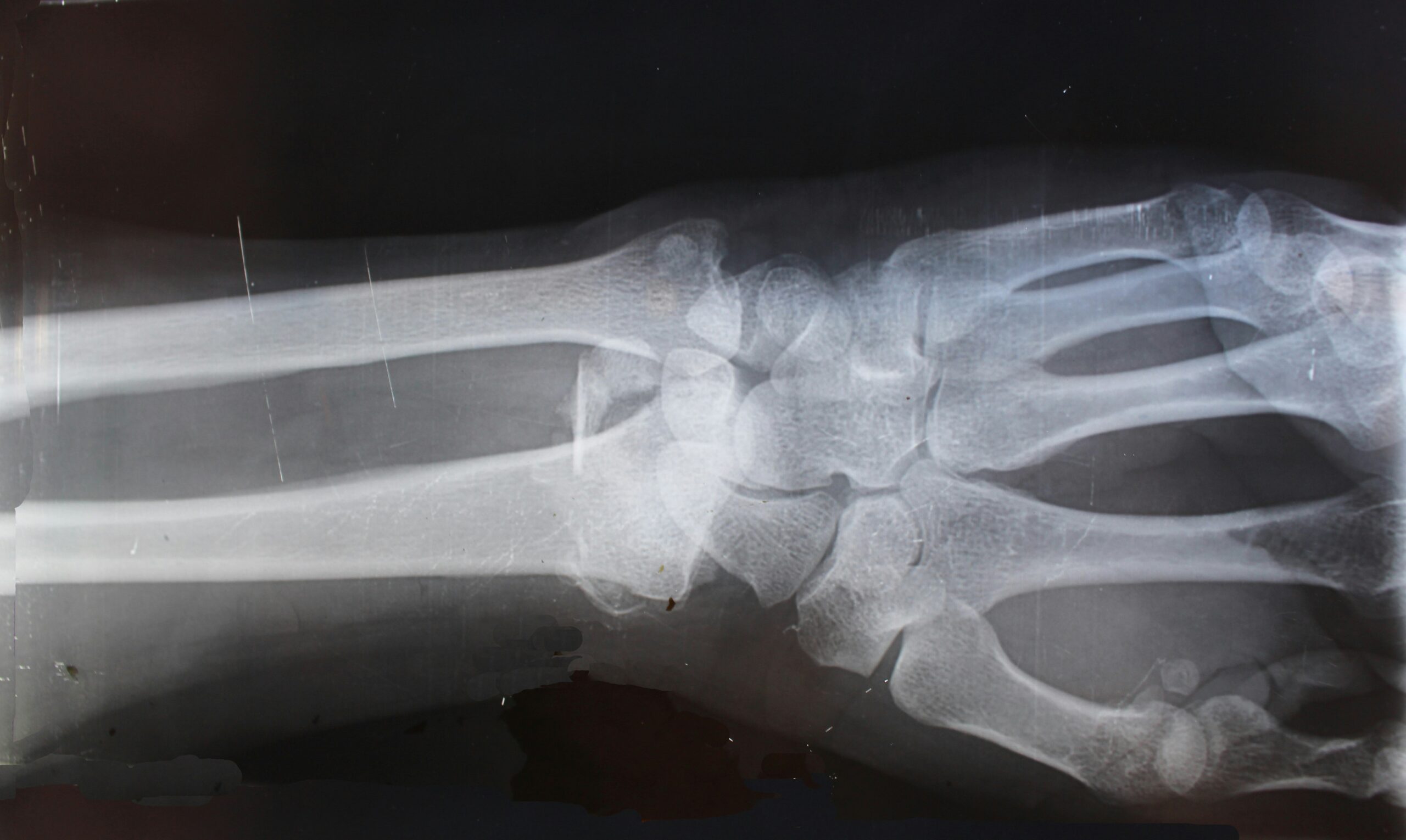 X-ray of lupus joint and muscle pain