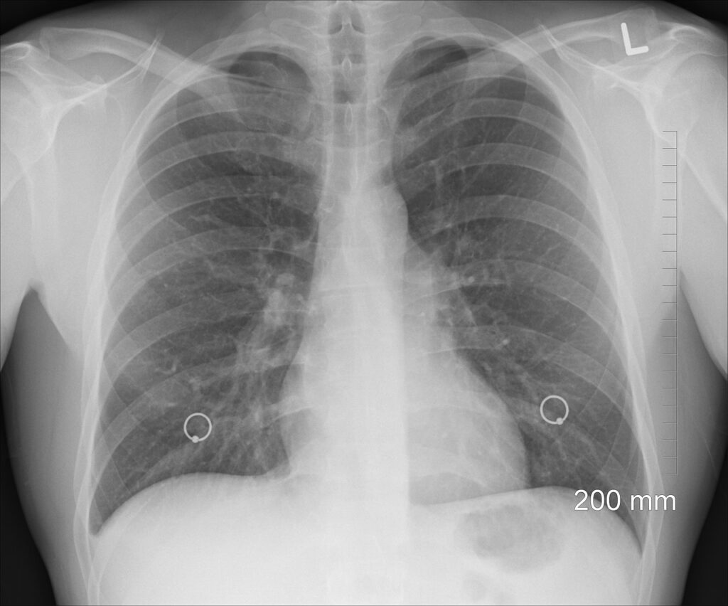 X-ray of respiratory system