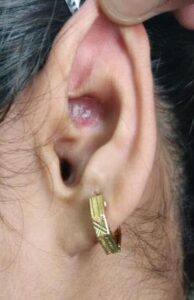 Discoid lupus on ear of white woman with lupus