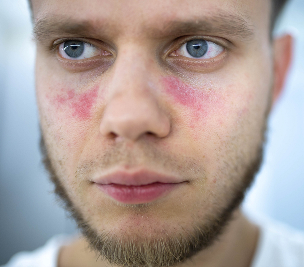 white male lupus patient with a lupus malar rash